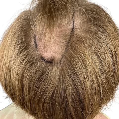 The crown can be one of the most challenging areas to restore because coverage has to work naturally
