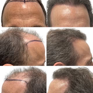 Your 50s don’t have to mean accepting the hair loss that happened in your 30s and 40s. A hair transp