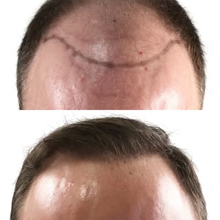 Going from almost no hair on top to having a full, natural-looking hairline can be a huge life-chang