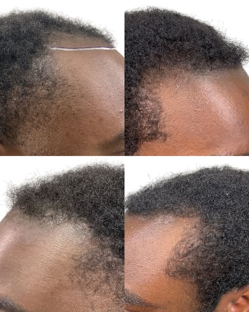 2,000 FUE grafts. Six months in, the hairline is already coming together with stronger density, clea