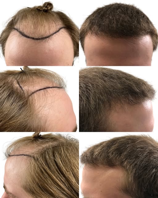 One angle never tells the full story. Seeing a hair transplant from the front, sides, and profile gi