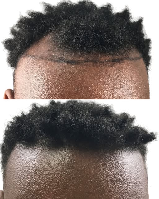 A hair transplant can be truly life changing when the improvement is significant. Restoring a fuller