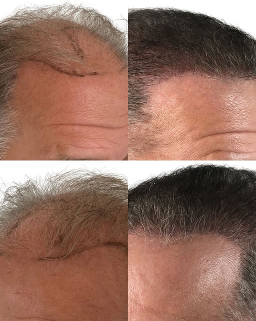 For someone who’s spent years watching their hairline slowly change, seeing this kind of transformat