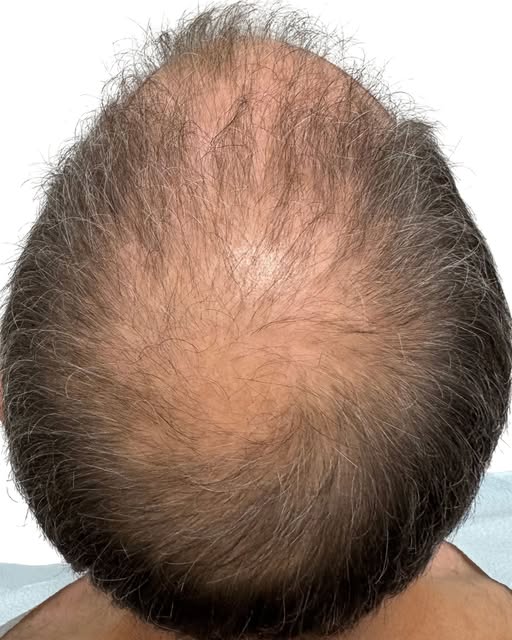 Understanding crown hair loss starts with recognizing the unique anatomy and growth pattern of the a