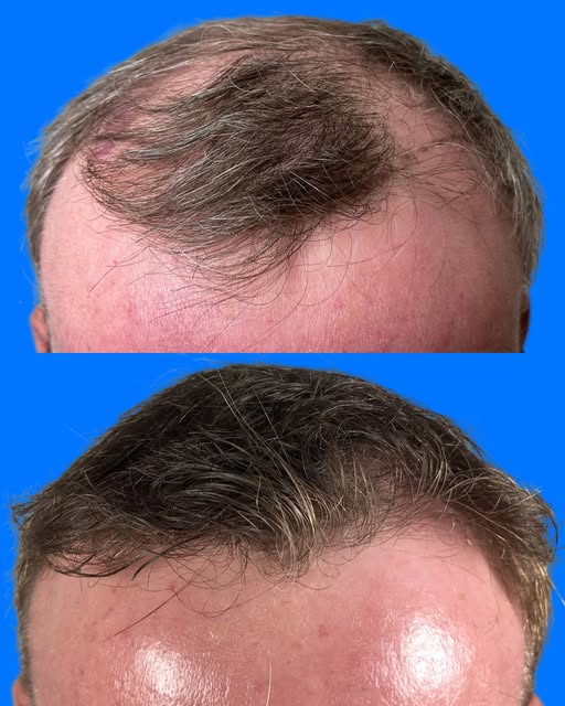 Hair restoration isn't just about adding more hair. It's also about how that hair grows, falls, and 