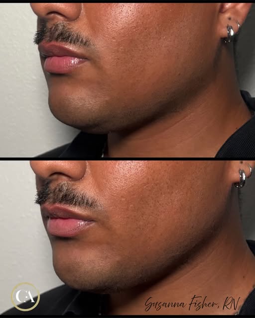 will never get over this snatched jawline using Juvederm Volux and MD Codes techniques🖤 schedule yo