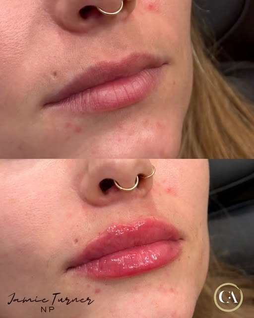 A little Lip Love goes a long way 💋 @jamieturner_npinjector