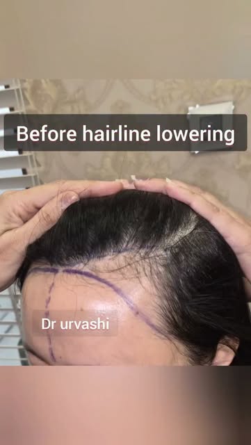 Imaginr getting a hair transplant done without shaving! 
So helpful for women who want to bring thei