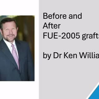 Follicular Unit Excision(FUE) by Dr Ken Williams using WAW  harvesting instrument. For Rome, documen