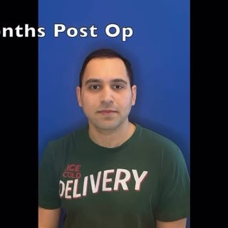 Dr. Williams demonstrates six months postop early results in a young male with hair loss.#hairbywill