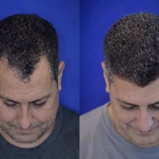 Dr. Williams demonstrates the art of the science of hair restoration surgery with before and after s