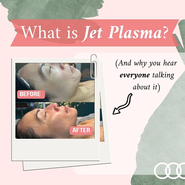 Here’s why Jet Plasma is redefining the skin rejuvenation industry: ✨🌿

✔️ Works at the cellular le
