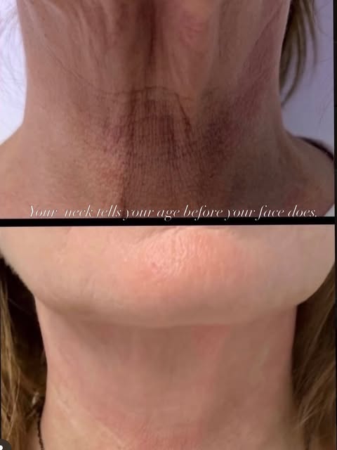 Your neck tells your age before your face does. 🌸

This is after 3 sessions with our new Ultra Cold