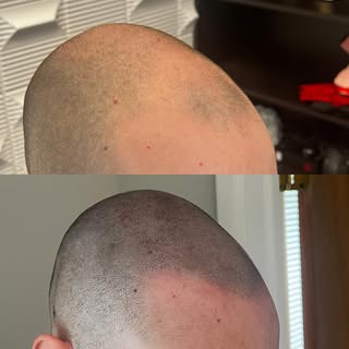 Good morning 🌞☀️ Nothing like a new hairline to start the week 😌