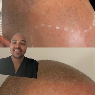 Another transformation!!! 🤙🏽🤙🏽🤙🏽 #ScalpMicropigmentation
#SMP
#HairLossSolution
#HairlineResto