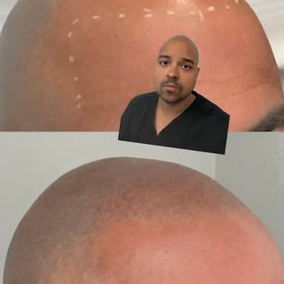 This ONE thing helped this guy go from looking COMPLETELY BALD , to a full head of short hair 😁😁 #