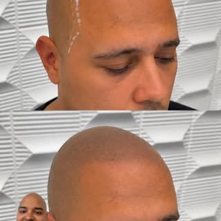 I love my job lol another fantastic result 😃😃#ScalpMicropigmentation
#SMP
#HairLossSolution
#Hairl