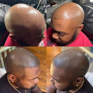 We do every hairloss style mane.  Our SMP is not partial to shaved heads or thinning hair.  We cover