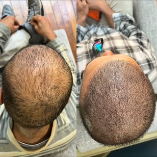 The density fill.  NOTE:  The client must have enough hair left to achieve these results.  The densi