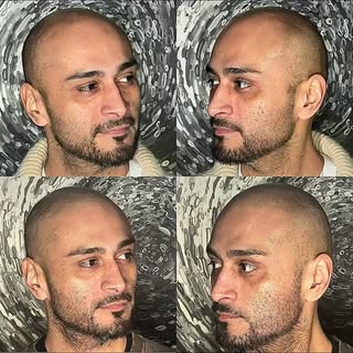 Nother little collage of some before and afters. 
#scalpmicropigmentation #smp #hairloss #hairtattoo