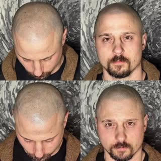 This is what a 4 year touchup looks like.  Brings the replication of the folicule back to life.