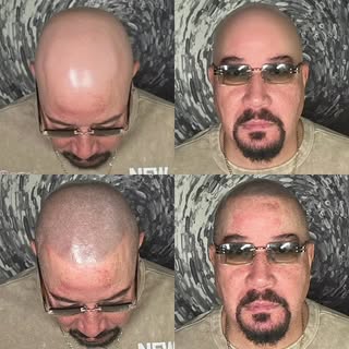 Another plethora of killer before and afters. 
#bald #hri #baldness #scalpmicro #hairlinerestoration