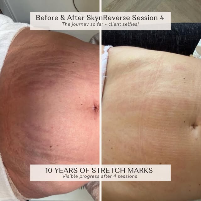 10 years of stretch marks — and look at the progress after just four sessions!

The first images you