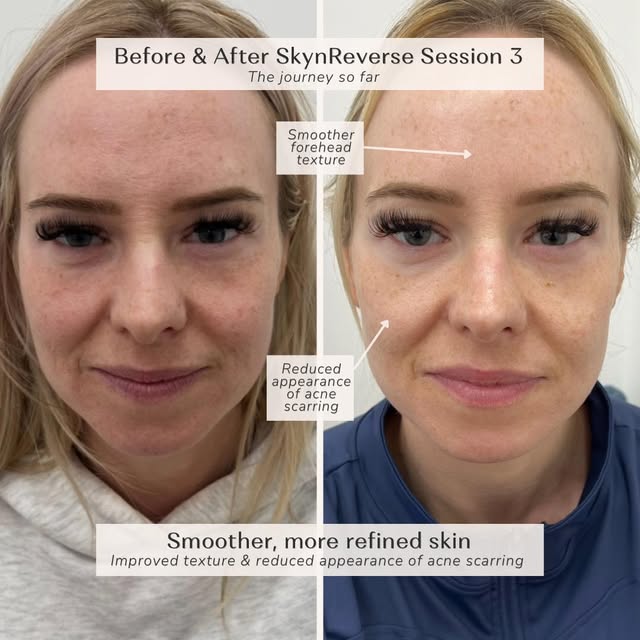 Sometimes you don’t need to treat the whole face to make a difference.

This client had SkynReverse 