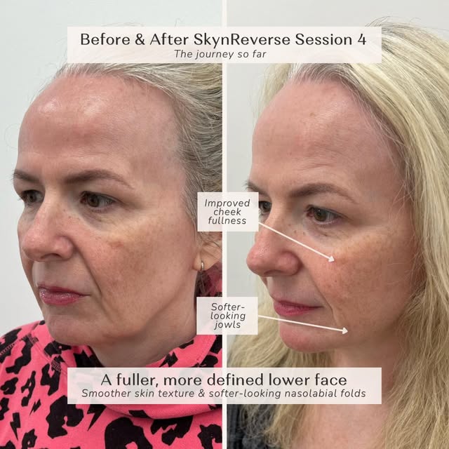 Restoring fullness after significant weight loss…

Significant weight loss is an incredible achievem