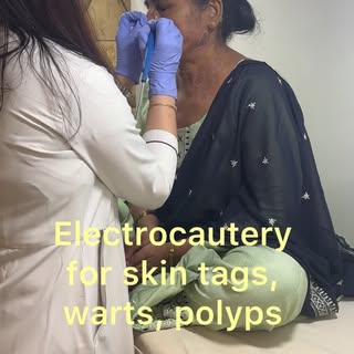 Electrocautery for skin tags, warts, polyps, extra growth.
It is a simple surgery technique that use