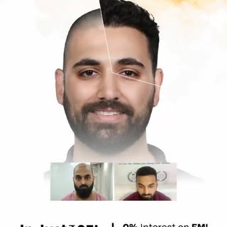 Hair transplant is a minimal invasive procedure done under local anesthesia. It restores hair in are