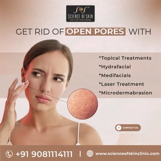 "Struggling with visible open pores? 🤔 They often occur due to excess oil, clogged debris, or aging