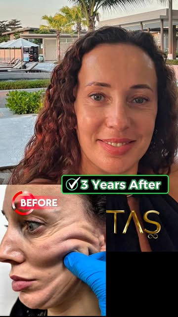 I am truly humbled to see my happy patients feedbacks 🙏🏻 3 Years After Full Facial Rejuvenation 🫶