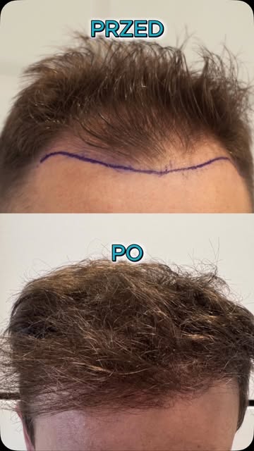 Cześć! 
 
Masz zakola lub zauważyłeś, że twoje włosy stają się coraz rzadsze? 

W Maritime Hair Cent