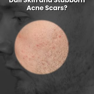 Worried about Dull Skin & Acne Scars? Pelle has got you covered with its Chemical Peel Treatment! Vi