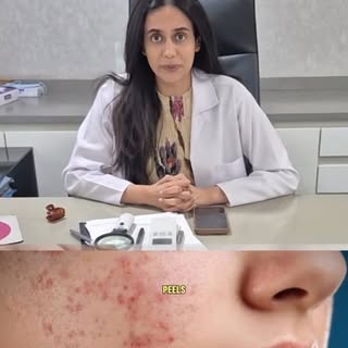 Acne can be treated- breakouts can be treated. 

Get clean and clear skin today. 

Permanent solutio