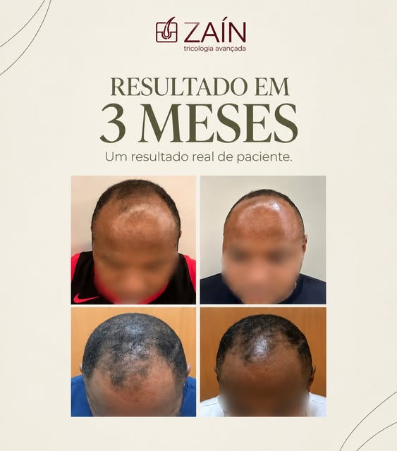 Resultado real, evolução que fala por si. ✨
Em apenas 3 meses, já é possível perceber mudanças impor