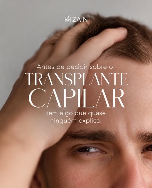 Muita gente acredita que o transplante capilar encerra de vez a preocupação com a calvície. Mas o cu