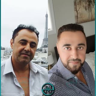 نتیجه موفقانه مشتری عزیز ما پس از انجام کاشت مو رشد  طبیعی وفوق العاده که میتواند اعتماد بنفس شمارا 