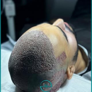 ✨ طبیعی بودن و تراکم در کنار هم! ✨
در Max Hair Center  کاشت  ۴۷۰۰ گرافت  با تکنیک FUE Saphir 
🔬 تمر