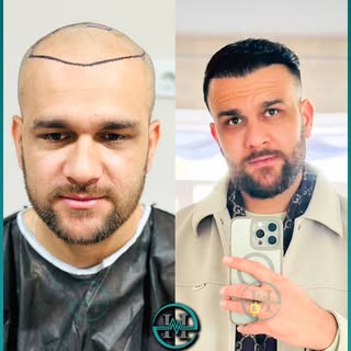 برای دستیابی به طبیعی ترین نتایج پرتراکم برنامه ریزی دقیق وتکنیک مناسب ضروری است.
نتیجه ۴۵۰۰گرافت با