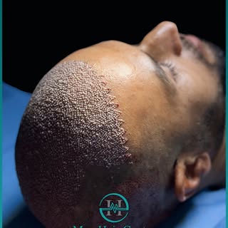 ✨ تراکم طبیعی، خط رویش زیبا! ✨
در Max Hair Center با کاشت ۴۳۰۰ گرافت، اولین قدم به سوی ظاهر جدید مشت