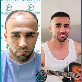✨ ظاهر جدید، اعتماد به نفس جدید! ✨
در مرکزما با تکنیک Sapphire FU ۵۰۰۰ گرافت کاشت نمودیم 

🔬 تمرکزد