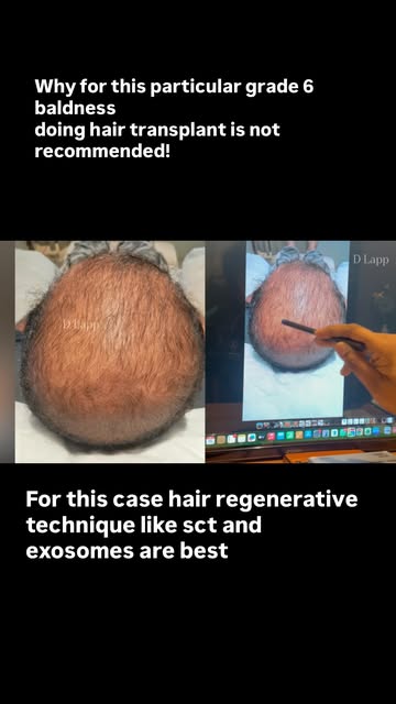 Why for this particular Grade 6 baldness hair transplant will not work? Instead why sct should be do