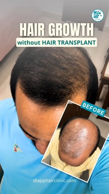 #dlapp #hairgrowth #hairlosstreatment #hairtransformation #baldnesssolution