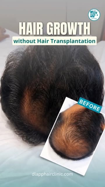 #dlapp #hairgrowth #hairlosstreatment #hairtransformation #baldnesssolution