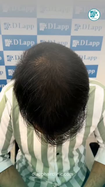 #dlapp #hairgrowth #hairlosstreatment #hairtransformation #baldnesssolution