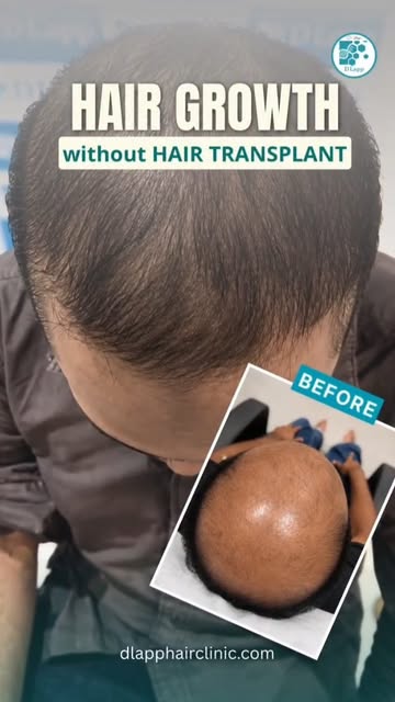 Hair growth without transplantation. #dlapp #hairtransformation #hairlosstreatment #baldnesssolution