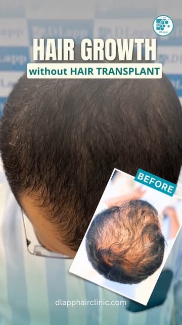 1 YEAR RESULT BY FSC ACTIVATION. 
No transplantation|No graftings|No surgeries
#dlapp #hairgrowth #h