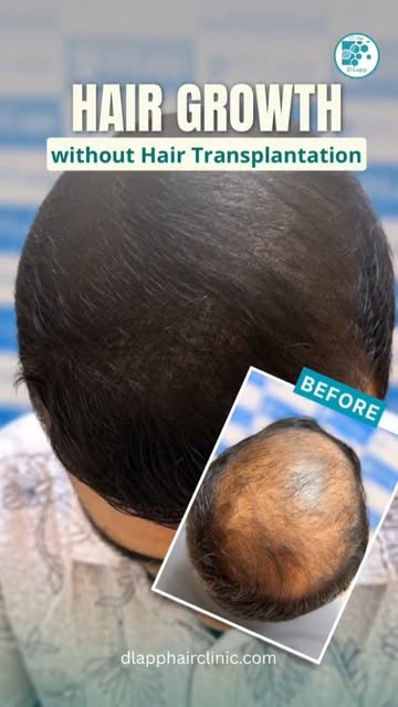 #dlapp #hairlosstreatment #hairgrowth #hairtransformation #beforeandafter